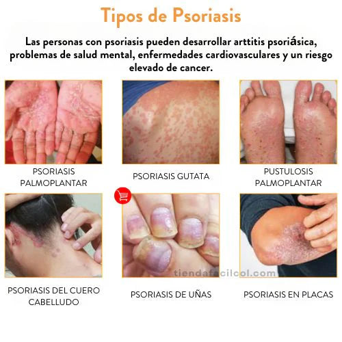 Kolmax 2x1 Spray Psoriasis