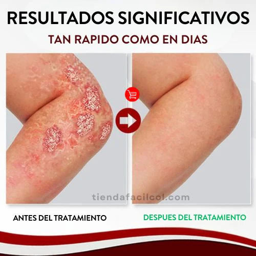 Kolmax 2x1 Spray Psoriasis